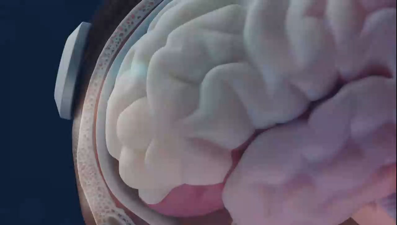 Illustration du Prophetic Phase : réseau ultrasonore placé près du cortex